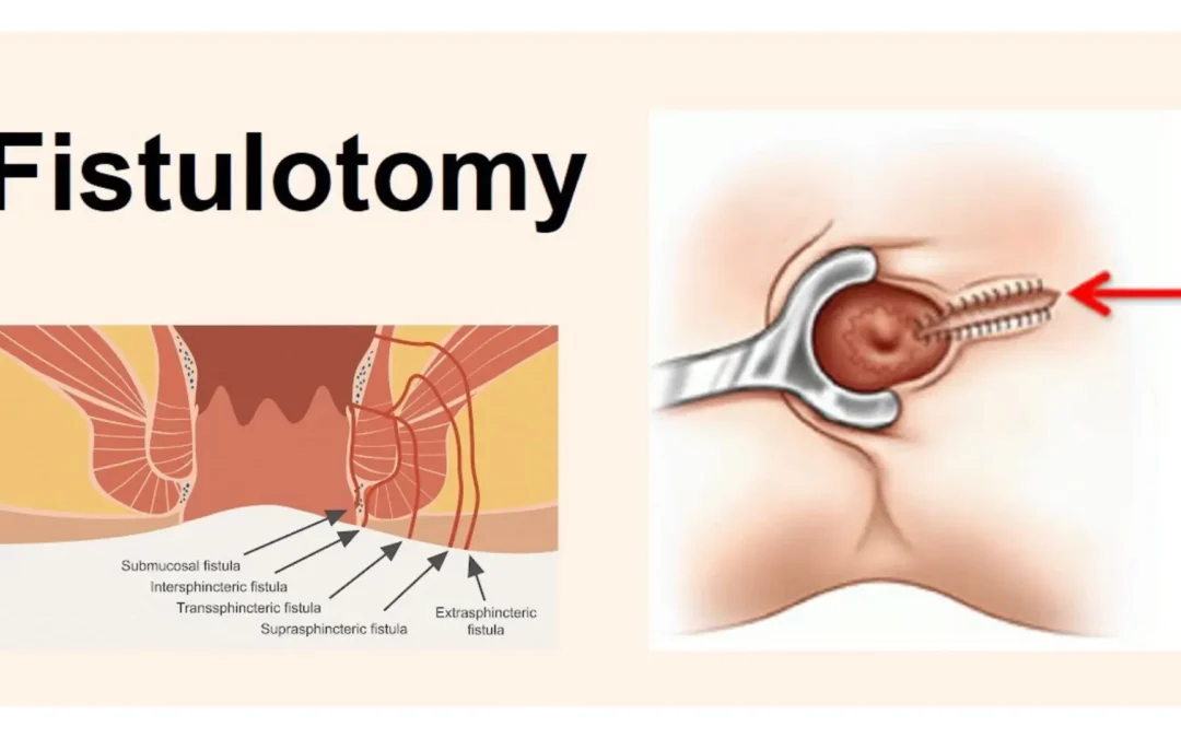 What Is Fistulotomy?